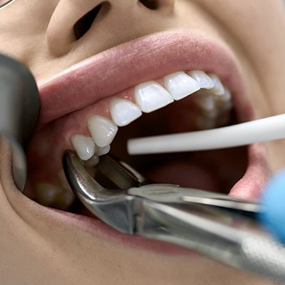 A patient receiving tooth extractions in Rockwall