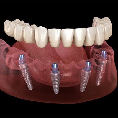 a 3D digital illustration of all-on-4 dental implants