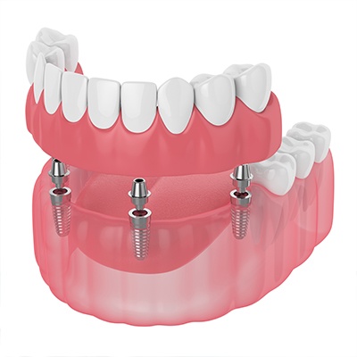 Animated dental implant retained dentures