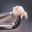 Metal clasp holding knocked out tooth