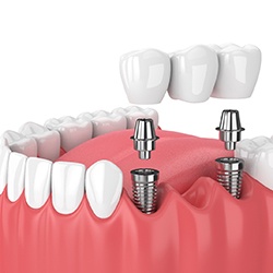 implant bridge illustration for cost of dental implants in Rockwall  