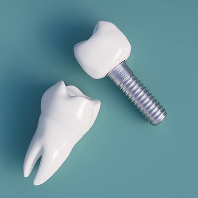3-D rendering of a tooth and a dental implant