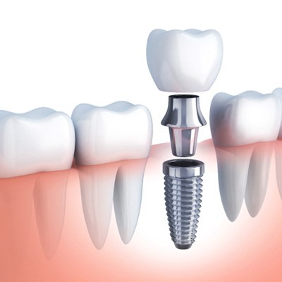 Digital illustration of a dental implant in Rockwall 