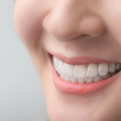 Closeup of woman smiling while wearing clear aligners
