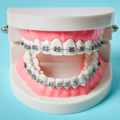Braces on a set of model teeth