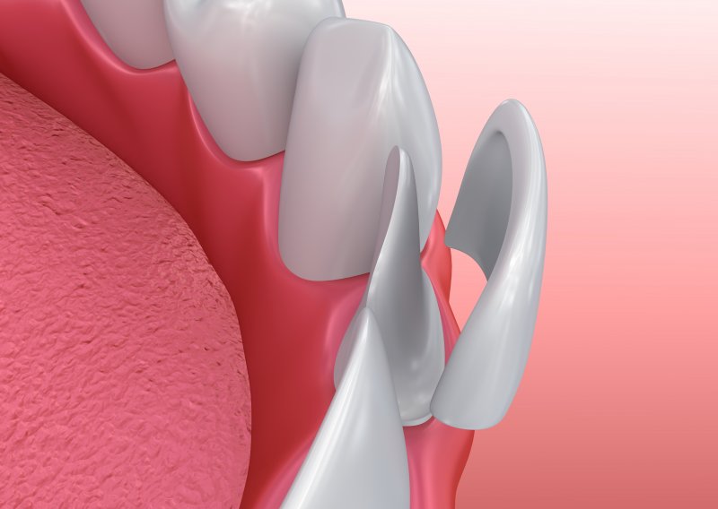 example of enamel removed for veneers in Rockwall