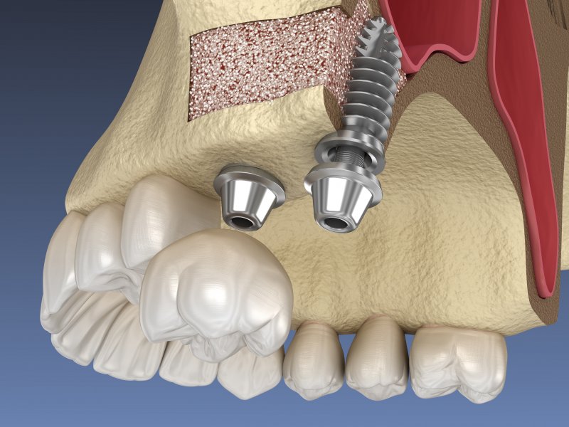 Sinus lift