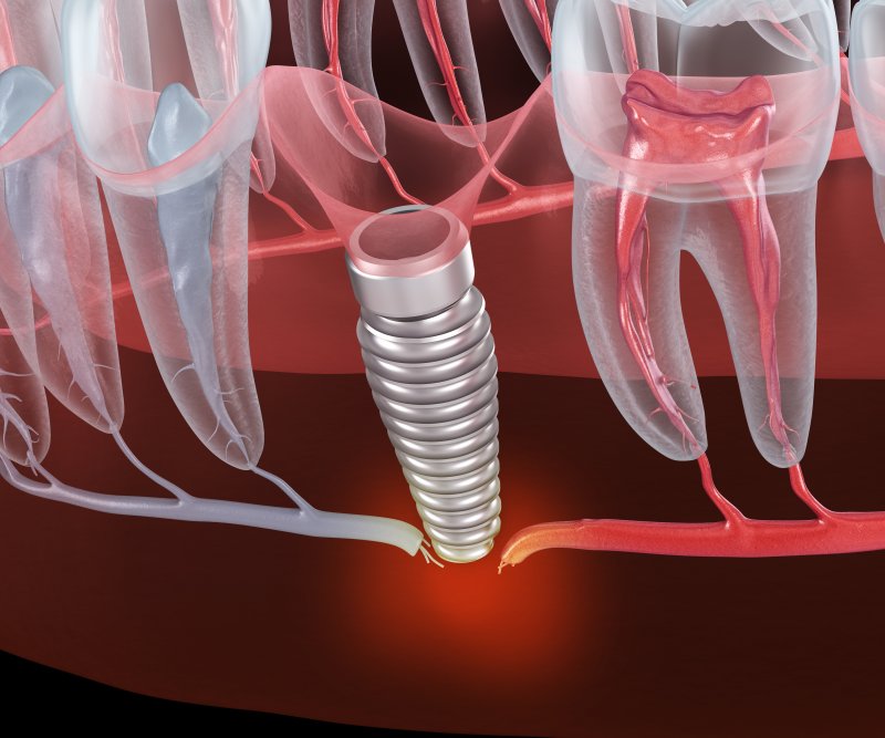 a failed dental implant