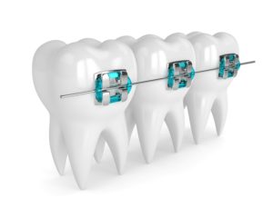 Illustration of 3 teeth with braces and a wire installed